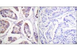 Immunohistochemistry analysis of paraffin-embedded human breast carcinoma tissue, using Vinculin (Ab-821) Antibody. (Vinculin antibody  (AA 786-835))