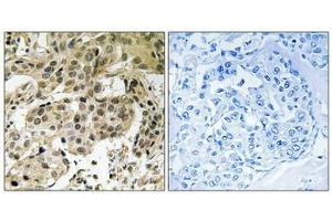 Immunohistochemical analysis of paraffin-embedded human breast carcinoma tissue using HP1α (Phospho-Ser92) antibody (left)or the same antibody preincubated with blocking peptide (right). (CBX5 antibody  (pSer92))