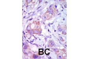 Formalin-fixed and paraffin-embedded human cancer tissue reacted with the primary antibody, which was peroxidase-conjugated to the secondary antibody, followed by DAB staining. (MAP3K9 antibody  (C-Term))