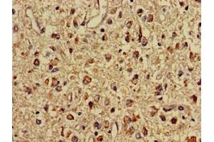 Immunohistochemistry of paraffin-embedded human glioma using ABIN7159696 at dilution of 1:100