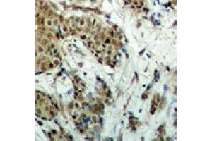 Immunohistochemical analysis of EVI1 staining in human breast cancer formalin fixed paraffin embedded tissue section. (MECOM antibody)