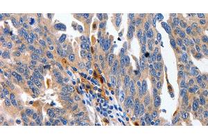 Immunohistochemistry of paraffin-embedded Human ovarian cancer using IL18 Polyclonal Antibody at dilution of 1:100