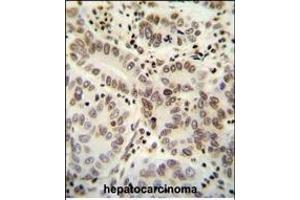 HIST1H2B antibody (Center) (ABIN654684 and ABIN2844377) immunohistochemistry analysis in formalin fixed and paraffin embedded human hepatocarcinoma followed by peroxidase conjugation of the secondary antibody and DAB staining. (HIST1H2BJ antibody  (AA 57-86))