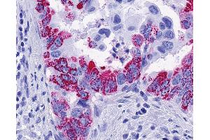 Anti-FFAR2 / GPR43 antibody IHC of human Pancreas, Carcinoma. (FFAR2 antibody  (Cytoplasmic Domain))