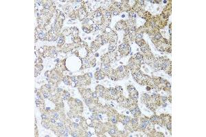Immunohistochemistry of paraffin-embedded human liver injury using TSG101 antibody (ABIN5999112) at dilution of 1/100 (40x lens).