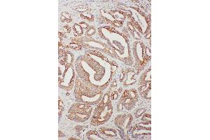 Anti-TNFAIP8L3 antibody, IHC(P) IHC(P): Human Intestinal Cancer Tissue (TNFAIP8L3 antibody  (C-Term))