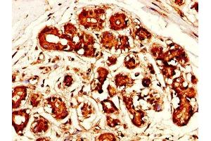 IHC image of ABIN7159428 diluted at 1:300 and staining in paraffin-embedded human breast cancer performed on a Leica BondTM system.