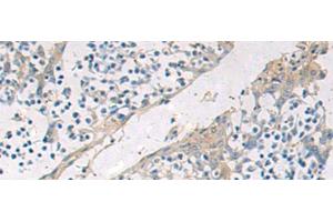 Immunohistochemistry of paraffin-embedded Human tonsil tissue using GBA Polyclonal Antibody at dilution of 1:55(x200) (GBA antibody)