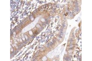 ABIN6277128 at 1/200 staining Human colon cancer tissue sections by IHC-P. (REG3g antibody)