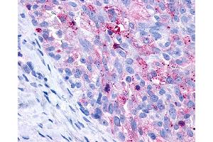 Anti-P2Y10 / P2RY10 antibody IHC of human Ovary, Carcinoma. (P2RY10 antibody  (C-Term))