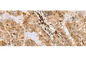 Immunohistochemistry of paraffin-embedded Human thyroid cancer tissue using ASNA1 Polyclonal Antibody at dilution of 1:70(x200) (ASNA1 antibody)