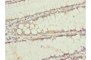 Immunohistochemistry of paraffin-embedded human colon cancer using ABIN7159902 at dilution of 1:100 (TIMM17B antibody  (AA 1-172))