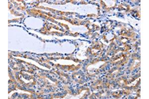 The image on the left is immunohistochemistry of paraffin-embedded Human thyroid cancer tissue using ABIN7191274(LIF Antibody) at dilution 1/25, on the right is treated with synthetic peptide. (LIF antibody)