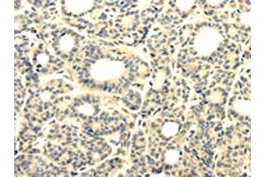 The image on the left is immunohistochemistry of paraffin-embedded Human thyroid cancer tissue using ABIN7131302(TBC1D22A Antibody) at dilution 1/25, on the right is treated with fusion protein. (TBC1D22A antibody)