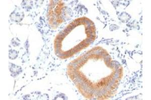 Immunohistochemical staining (Formalin-fixed paraffin-embedded sections) of human melanoma with CD86 monoclonal antibody, clone C86/1146 . (CD86 antibody)