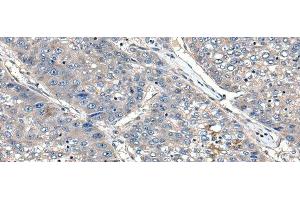 Immunohistochemistry of paraffin-embedded Human liver cancer tissue using XDH Polyclonal Antibody at dilution of 1:85(x200) (XDH antibody)