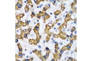 Immunohistochemical analysis of VAP-B/C staining in human liver cancer formalin fixed paraffin embedded tissue section. (VAPB antibody)