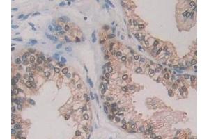 Detection of GR in Human Prostate Tissue using Polyclonal Antibody to Glutathione Reductase (GR) (Glutathione Reductase antibody  (AA 44-522))