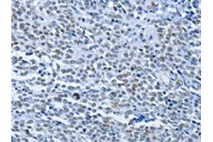 The image on the left is immunohistochemistry of paraffin-embedded Human ovarian cancer tissue using ABIN7190072(CBX1 Antibody) at dilution 1/30, on the right is treated with synthetic peptide. (CBX1 antibody)