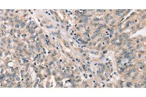 Immunohistochemistry of paraffin-embedded Human ovarian cancer tissue using CDK12 Polyclonal Antibody at dilution 1:30 (CDK12 antibody)