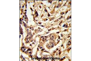 Formalin-fixed and paraffin-embedded human breast carcinoma reacted with GALT Antibody , which was peroxidase-conjugated to the secondary antibody, followed by DAB staining. (GALT antibody  (C-Term))