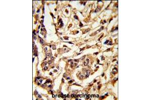 Formalin-fixed and paraffin-embedded human breast carcinoma reacted with GALT Antibody , which was peroxidase-conjugated to the secondary antibody, followed by DAB staining. (GALT antibody  (C-Term))