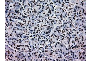 Immunohistochemical staining of paraffin-embedded Adenocarcinoma of colon tissue using anti-MAPK1mouse monoclonal antibody. (ERK2 antibody)