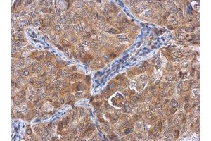 IHC-P Image ACTL8 antibody detects ACTL8 protein at cytoplasm in human lung cancer by immunohistochemical analysis. (Actin-Like 8 antibody)
