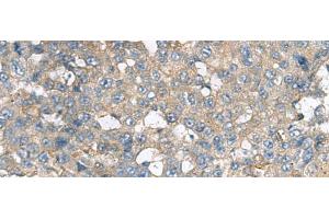 Immunohistochemistry of paraffin-embedded Human liver cancer tissue using CXCR5 Polyclonal Antibody at dilution of 1:80(x200) (CXCR5 antibody)