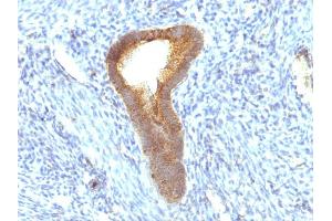 Formalin-fixed, paraffin-embedded human Endometrial Carcinoma stained with Alkaline Phosphatase Mouse Monoclonal Antibody (ALPL/597). (ALPL antibody)