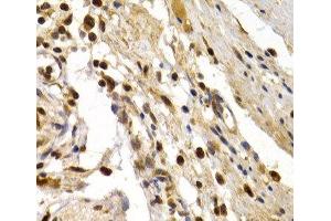 Immunohistochemistry of paraffin-embedded Human colon damage using TFDP1 Polyclonal Antibody at dilution of 1:200 (40x lens). (DP1 antibody)