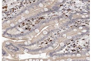 ABIN6266583 at 1/100 staining human colon carcinoma tissue sections by IHC-P. (SCGB2A1 antibody  (Internal Region))