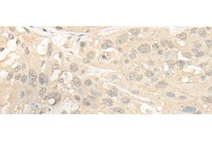 Immunohistochemistry of paraffin-embedded Human esophagus cancer tissue using CYP4X1 Polyclonal Antibody at dilution of 1:40(x200) (CYP4X1 antibody)
