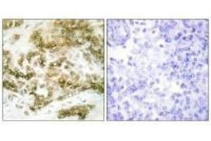 Immunohistochemistry analysis of paraffin-embedded human breast carcinoma tissue using TBX15/18 antibody. (T-Box 15 antibody)