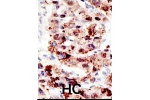 Formalin-fixed and paraffin-embedded human cancer tissue reacted with the primary antibody, which was peroxidase-conjugated to the secondary antibody, followed by AEC staining. (Ubiquitin antibody  (AA 36-66))