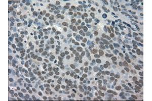 Immunohistochemical staining of paraffin-embedded Adenocarcinoma of breast tissue using anti-TRIB2 mouse monoclonal antibody. (TRIB2 antibody)