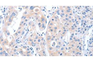 Immunohistochemistry of paraffin-embedded Human lung cancer tissue using ARHGEF6 Polyclonal Antibody at dilution 1:70 (ARHGEF6 antibody)