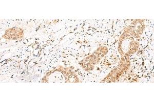 Immunohistochemistry of paraffin-embedded Human esophagus cancer tissue using PRKAG2 Polyclonal Antibody at dilution of 1:55(x200) (PRKAG2 antibody)