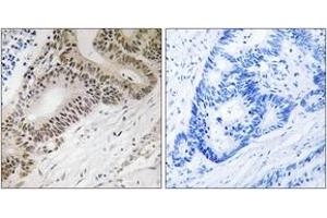 Immunohistochemistry analysis of paraffin-embedded human colon carcinoma tissue, using FOXO3A (Ab-315) Antibody. (FOXO3 antibody  (AA 281-330))