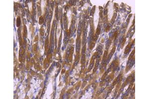 Paraformaldehyde-fixed, paraffin embedded Human breast carcinoma, Antigen retrieval by boiling in sodium citrate buffer (pH6) for 15min, Block endogenous peroxidase by 3% hydrogen peroxide for 30 minutes, Blocking buffer at 37°C for 20min, Antibody incubation with ERK2 (3G1) Monoclonal Antibody  at 1:50 overnight at 4°C, followed by a conjugated secondary and DAB staining. (ERK2 antibody)
