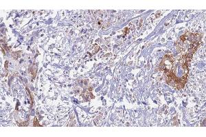 ABIN6269237 at 1/100 staining Human urothelial cancer tissue by IHC-P. (CD130/gp130 antibody  (C-Term))
