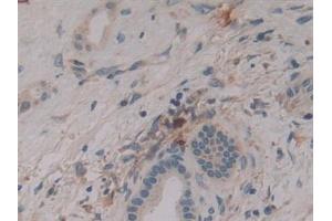 Detection of DNM2 in Human Liver cancer Tissue using Polyclonal Antibody to Dynamin 2 (DNM2) (DNM2 antibody  (AA 533-731))