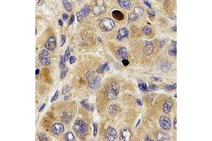 Immunohistochemical analysis of MPP2 staining in human liver cancer formalin fixed paraffin embedded tissue section. (MPP2 antibody)