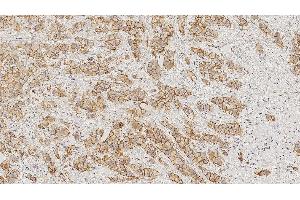 Invasive breast carcinoma: immunohistochemical staining for E-Cadherin. (E-cadherin antibody  (N-Term))