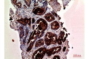 Immunohistochemistry (IHC) analysis of paraffin-embedded Human Prostate Cancer, antibody was diluted at 1:100. (Prostate Specific Antigen antibody  (Internal Region))