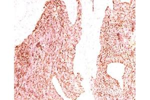 IHC testing of human small cell lung carcinoma stained with Chromogranin A antibody. (Chromogranin A antibody)
