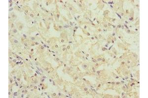 Immunohistochemistry of paraffin-embedded human gastric cancer using ABIN7147407 at dilution of 1:100 (CEP44 antibody  (AA 1-280))