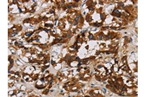 The image is immunohistochemistry of paraffin-embedded Human thyroid cancer tissue using ABIN7128636(BCL2L12 Antibody) at dilution 1/20.