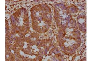 IHC image of ABIN7139920 diluted at 1:200 and staining in paraffin-embedded human colon cancer performed on a Leica BondTM system. (LPAR6 antibody  (AA 292-313))