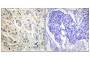 Immunohistochemistry analysis of paraffin-embedded human colon carcinoma tissue using p90 RSK (Ab-573) antibody. (RPS6KA1 antibody  (Thr573))
